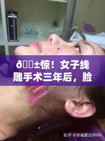 😱惊！女子线雕手术三年后，脸上竟“长”出一根线？！